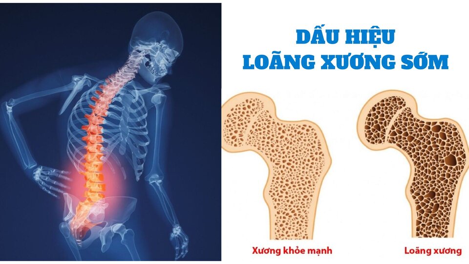 5 dấu hiệu cảnh báo sớm của bệnh loãng xương